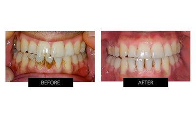 Before and After review of the Silk'n Toothwave Toothbrush