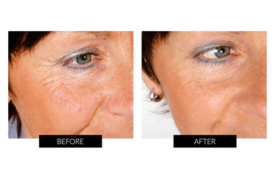 Trophy Skin MiniMD Handheld Portable Microdermabrasion Device